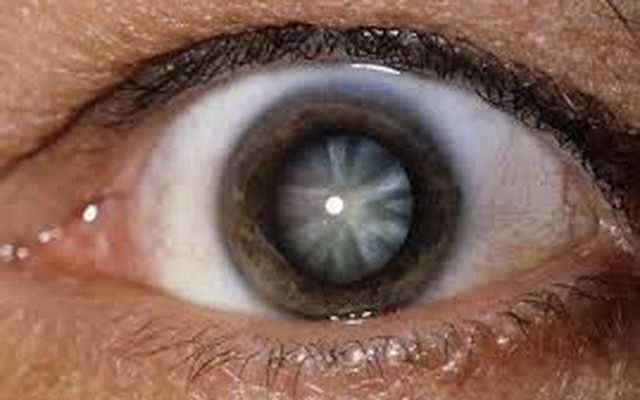 Các bệnh về mắt phổ biến thường gặp - Bệnh Viện Mắt Sài Gòn
