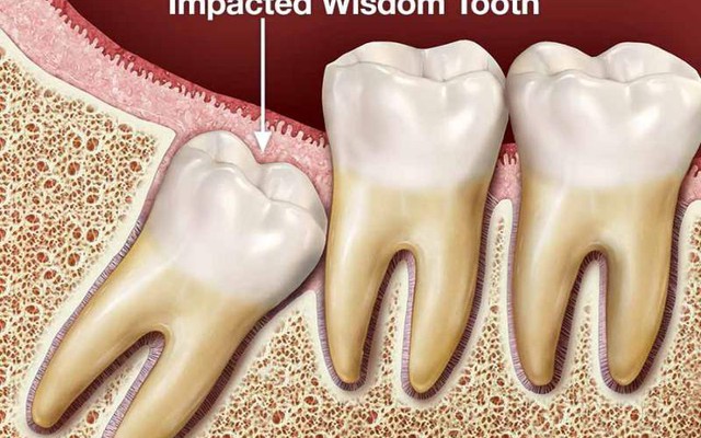 Tại sao nhổ răng khôn có thể gây tử vong?
