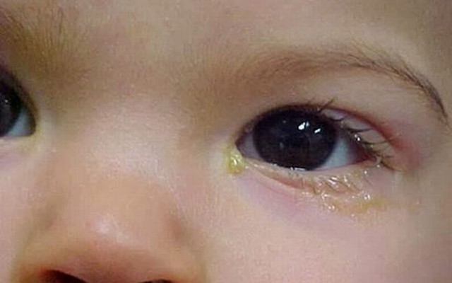 Mắt ra ghèn nhiều có liên quan đến sự khô mắt hay không?
