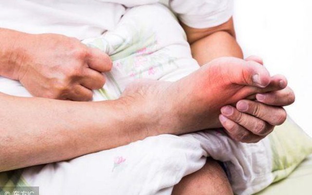 Gout là gì và nguyên nhân gây ra căn bệnh này?

