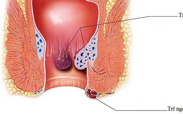 Chi tiết Hình ảnh thực tế bệnh trĩ nội và trĩ ngoại theo các cấp độ