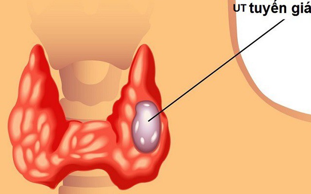 Các triệu chứng hay dấu hiệu nào có thể cho thấy bệnh nhân đang tái phát ung thư tuyến giáp sau phẫu thuật?
