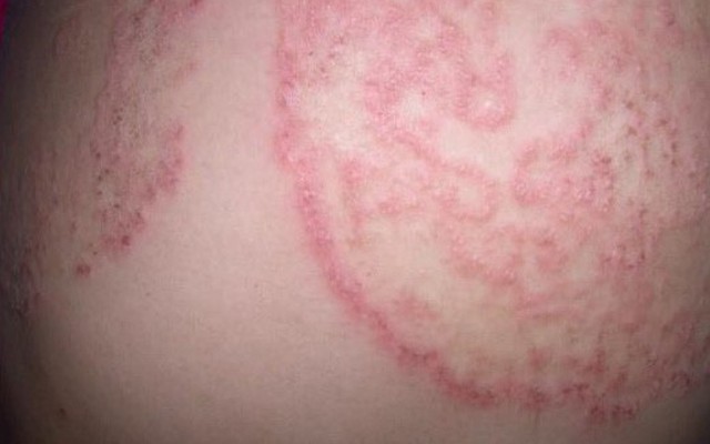 Loại bệnh nấm da nào lây truyền nhanh nhất và có thể gây biến chứng nghiêm trọng nhất?
