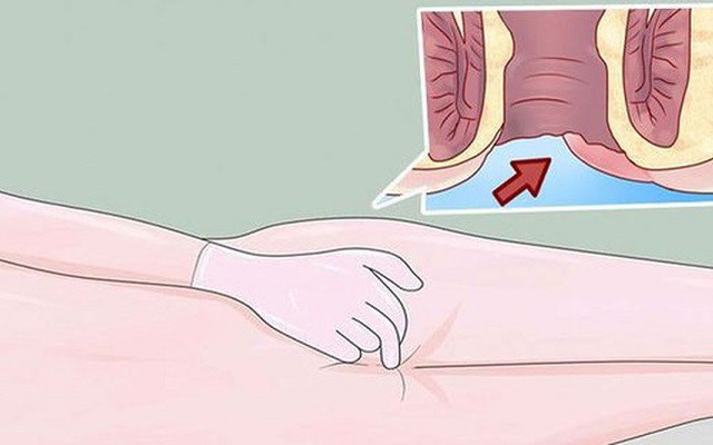 What are the causes and treatment options for a hard lump and pain in the anus?
