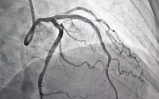 Bệnh nhân sau khi đặt stent mạch vành có thể hoạt động thể chất bình thường hay phải hạn chế?

