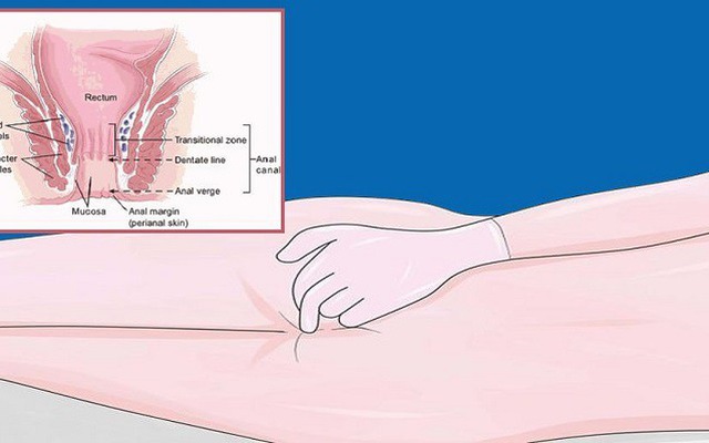 Có những loại thuốc nào giúp làm giảm ngứa và mùi hôi ở khu vực hậu môn?
