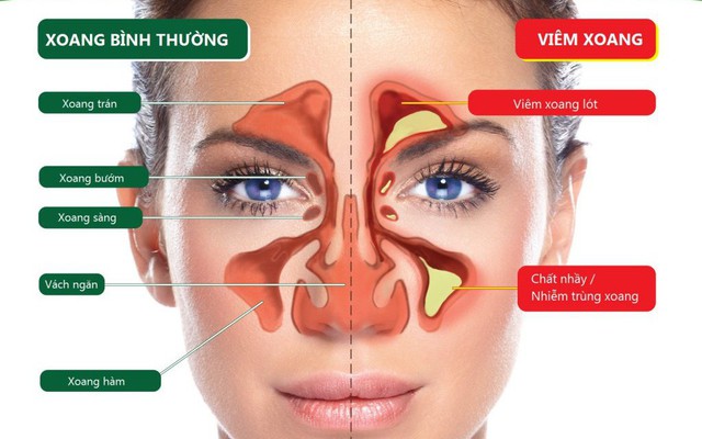 Các phương pháp chẩn đoán viêm xoang chảy mủ xuống họng là gì?
