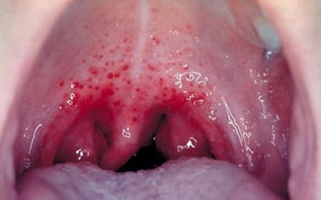 Ung thư vòm họng giai đoạn 1 Hình ảnh dấu hiệu và chữa trị