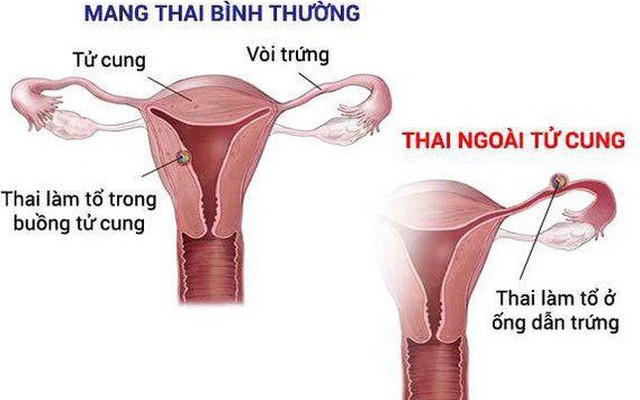 Hiểu biết thực sự về Thai ngoài tử cung và điều trị Thai ngoài tử cung bằng thuốc là cần thiết cho phụ nữ trong mọi độ tuổi hay chỉ riêng cho người đã từng mắc phải?