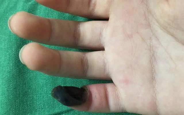 Có những biện pháp phòng ngừa mụn cóc ở ngón tay?
