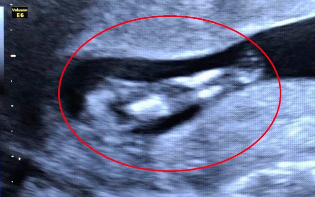 Siêu âm 4D thai 24 tuần hình ảnh thai cách đọc kết quả