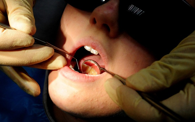 Cách điều trị ung thư răng hiệu quả nhất hiện nay là gì?
