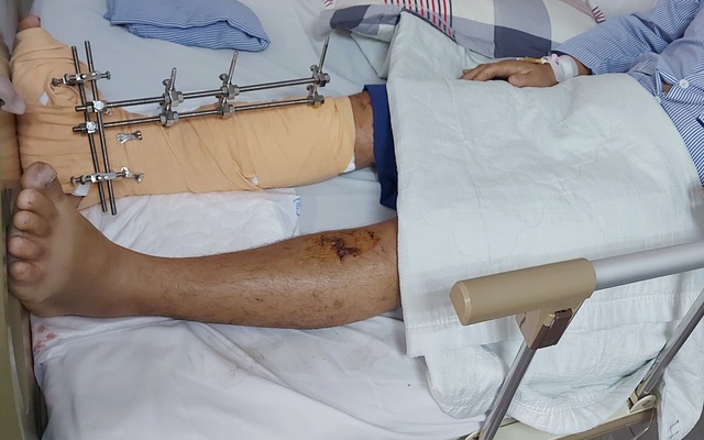 Cứu bệnh nhân dập nát cẳng chân do tai nạn giao thông | VTV.VN
