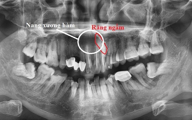 Sưng đau môi trên lâu ngày: Cẩn trọng có thể bạn mắc u xương hàm ...