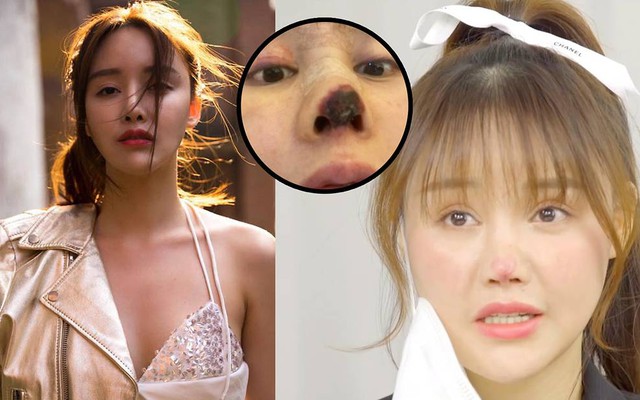 Nữ diễn viên Trung Quốc bị hoại tử mũi do phẫu thuật khuyên các cô ...