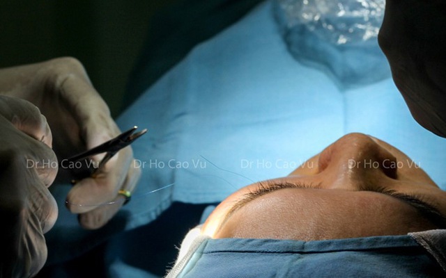 Có cần thực hiện các bước điều trị sau khi cắt mí mắt để giảm thâm và bầm?
