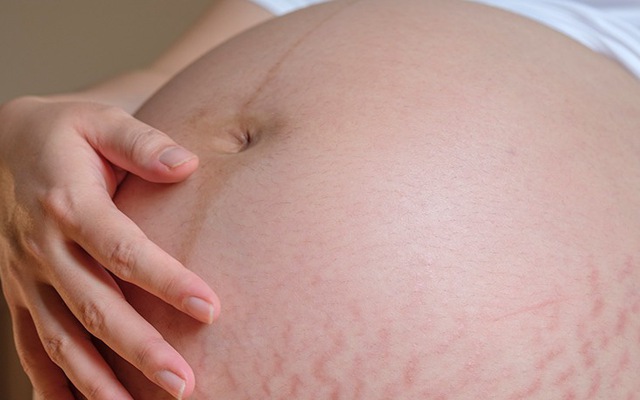 Rạn ngực sau khi mang thai có thể làm gì để giảm đi?
