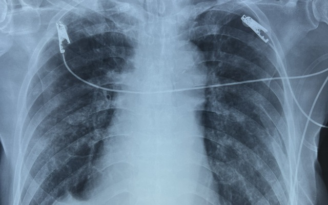 Cứu sống bệnh nhân ngưng tim, ngưng thở do tràn khí màng phổi | VTV.VN