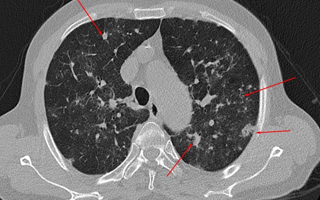 20 ngày sau khỏi COVID-19, nam bệnh nhân đi khám phát hiện phổi ...