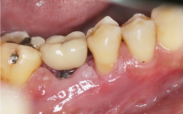 Có những nguy cơ nào liên quan đến việc trồng răng Implant giá rẻ không chính hãng?

