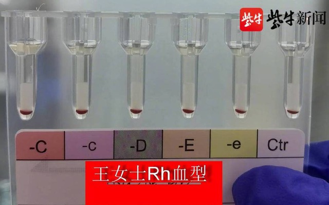 Quy ước của Hội Truyền máu Quốc tế về nhóm máu Rh(D) âm tại Việt Nam là gì?
