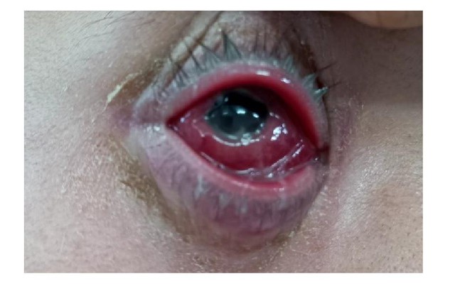 Bệnh lậu mắt ở nam có triệu chứng gì?
