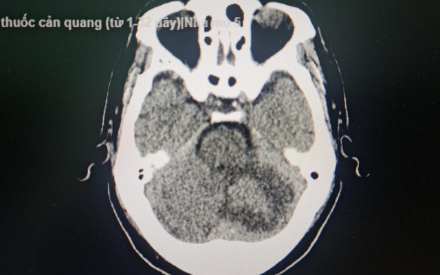 Đột ngột đau đầu, mất cân bằng, đi viện phát hiện khối u não | VTV.VN