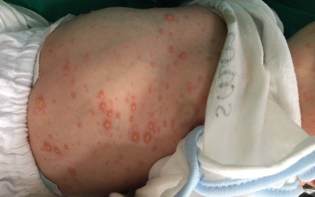 Vùng da nào trên cơ thể thường bị ảnh hưởng nặng nhất bởi bệnh thủy đậu? 
