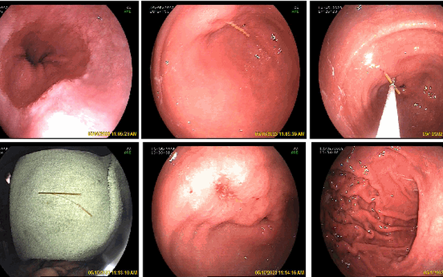 Gắp chiếc tăm dài gần 7cm găm sâu vào dạ dày bệnh nhân | VTV.VN
