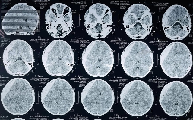 Chụp cắt lớp vi tính (CT) - Rối loạn thần kinh - Cẩm nang MSD - Phiên bản  dành cho chuyên gia