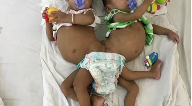 Conjoined twins successfully separated