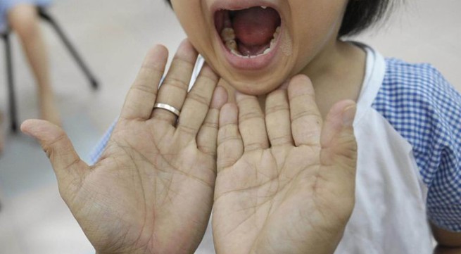 Hand, foot and mouth disease outbreak in Malaysia