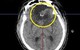Đi khám vì đau đầu, chóng mặt, người bệnh phát hiện khối u não lớn