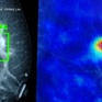 Ứng dụng AI giúp phát hiện ung thư vú qua sàng lọc nhũ ảnh