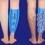 Tái phát sau điều trị suy giãn tĩnh mạch chân bằng laser xung dài